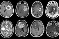 Más de 5.000 nuevos casos de tumores cerebrales diagnosticados anualmente en España